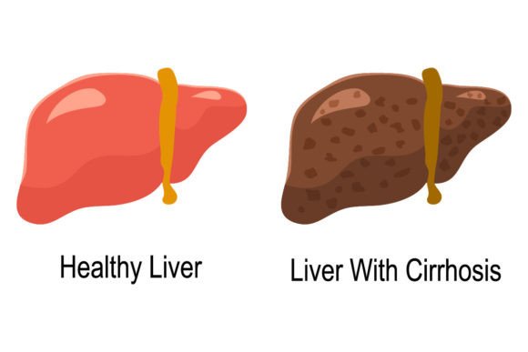 Comparison of Healthy Liver and Liver Graphics